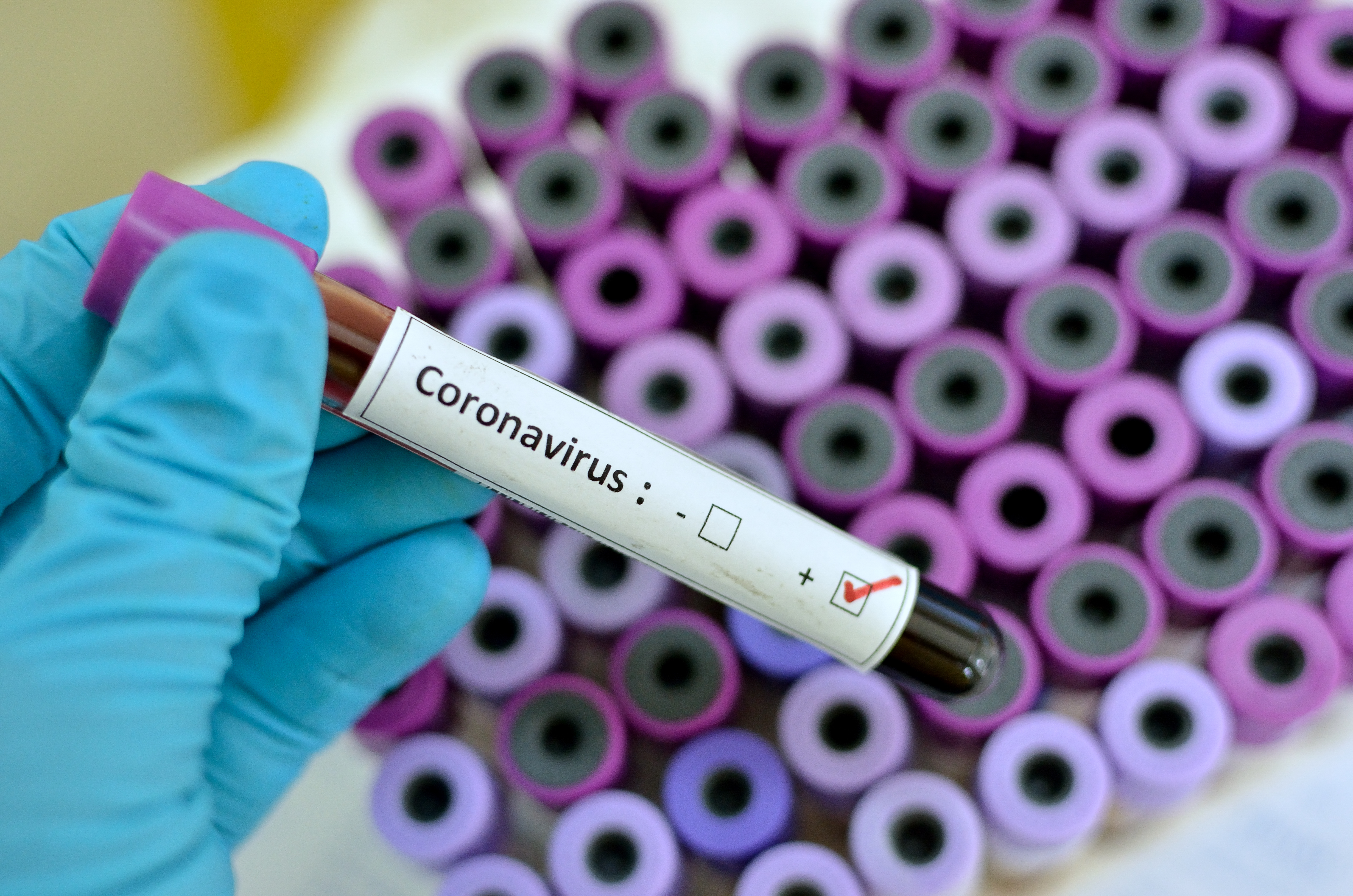 Coronavirus Sample Viles